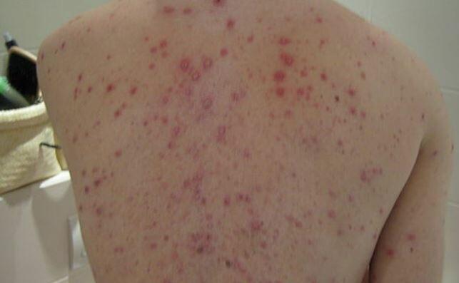 Mpox não é nova covid, diz diretor da OMS na Europa