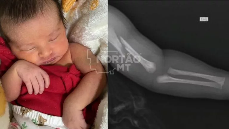 Recém-nascida sofre fratura durante parto em hospital de Sorriso; família denuncia negligência