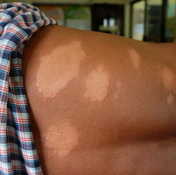 Prefeitura de Cuiabá intensifica ações de conscientização e combate à hanseníase